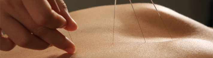 teparapia-acupuntura